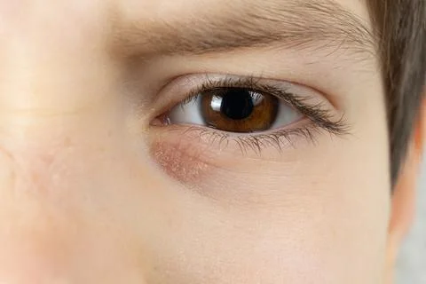 Red dry scaly patch of dermatitis under childs eye. Stock Photos