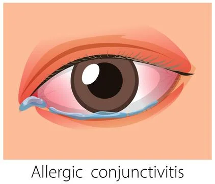Red Eye With Allergic Conjunctivitis Symptoms Illustration Stock Illustration