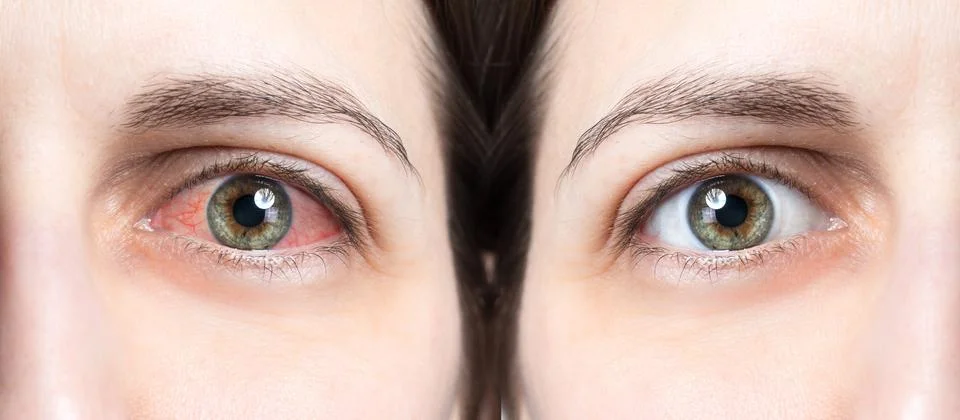 Red eye before and after using eye drops Fotos de archivo