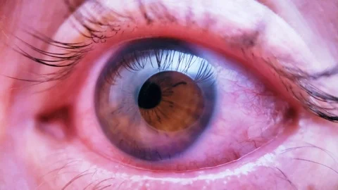 Red Eye Conjunctivitis or pinkeye symptom 4K Stock Footage 90097646