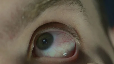 Red eye in a man, close-up Stock-Footage 123824746