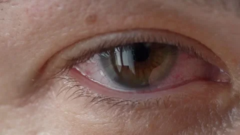 Red eye of a man Video stock 277719129