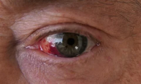 Red eye Stock Photos