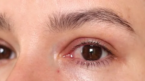 Red eye of a woman affected by conjunctivitis or after flu, cold or allergies Stock Footage 310265313