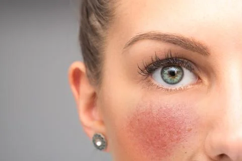Red flushing cheeks are seen closeup, in the face of a stunning thirty someth Stock-Fotos
