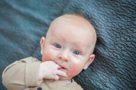 Red-haired boy with atopic dermatitis Stock Photos