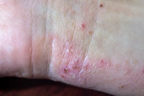 Red inflamed skin patch with small blisters and scaling on human hand surface Stock Photos