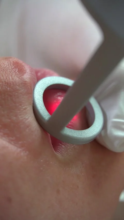 Red Light Lip Therapy - Advanced Beauty Technique Stock Footage 274090062