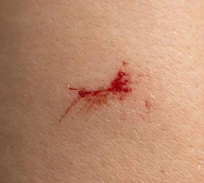 A red mark on a person's arm Stock Photos