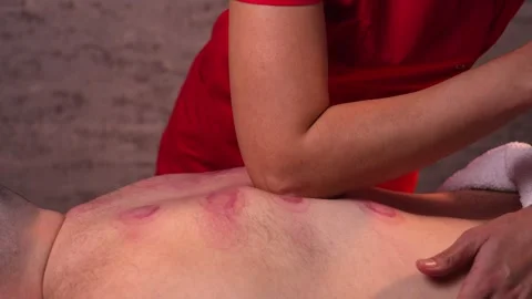 Red marks on back of man after removing acupuncture of hijama vacum cups. Stock Footage 266176094