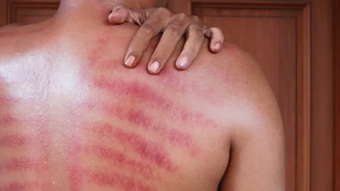 Red marks from scrapes coin Stock-Footage 332884132