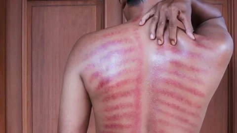 Red marks from scrapes coin Stock-Footage 332884138
