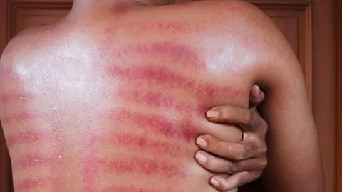 Red marks from scrapes coin Stock-Footage 332884139
