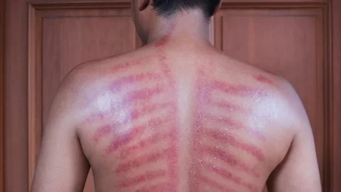 Red marks from scrapes coin Stock-Footage 332884141