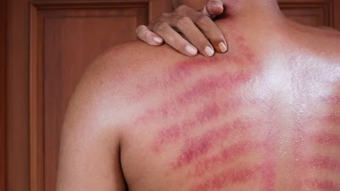 Red marks from scrapes coin Stock-Footage 332884144