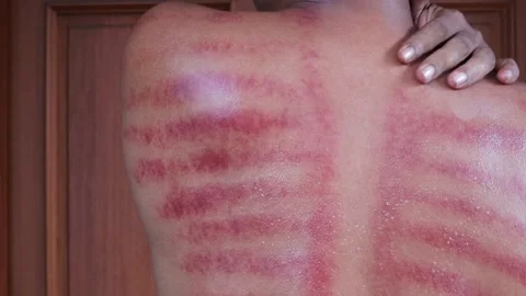 Red marks from scrapes coin Stock-Footage 332884175