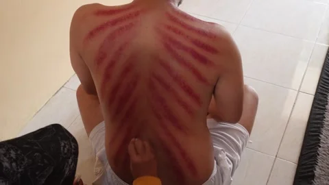 Red marks from scrapes coin on a man's back. Kerokan is a way of traditiona.. Stock Footage 251620346