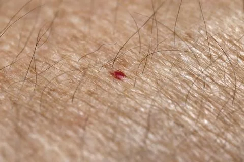 Red moles, also known as ruby dots or blood moles, appear on the skin in ar.. Stock Photos