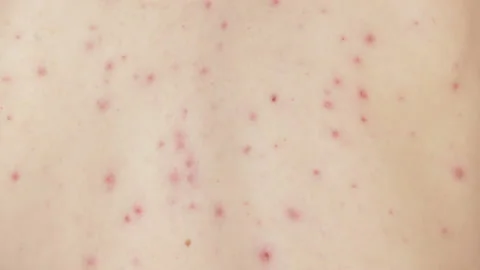 Red pimple and bubble rash from chickenpox Vídeo Stock 155889707