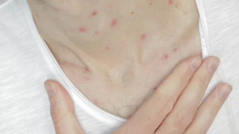 Rashes Stock Video Footage, Royalty Free Rashes Videos