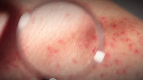 Red pimples on human skin through the magnifying glass Stock Footage 301377116