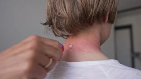Red pustules and vesicles on the skin of the neck as symptoms of photodermatitis Stock-Footage 171276321