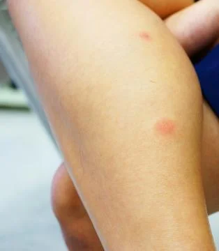 Red rash Stock Photos