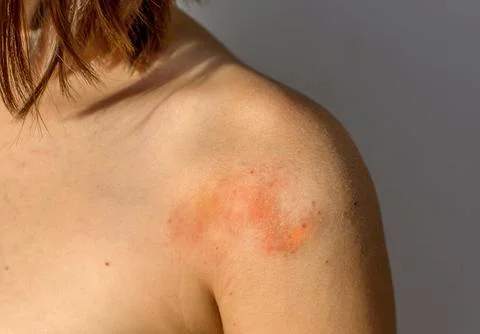 Red rough patch of atopic dermatitis on child's shoulder, skin disease concep Stock Photos