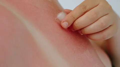 Red skin due to sunburn cooled by ice cube in woman hand closeup. Stock Footage 273237650