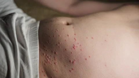 Red, Sore Insect Bites On A Caucasian Male's Stomach, belly. Insects Video stock 244698081