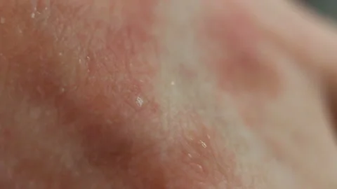 Red spots of the affected epithelium, peeling, severe itching, scabies. Atopic d Stock Footage 128996819