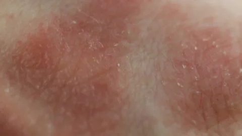 Red spots of the affected epithelium, severe itching, scabies. Atopic dermatitis Stock Footage 128996798