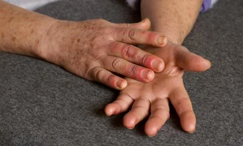 Reddened hands of a 60-year-old woman with Raynaud's syndrome Stock Photos