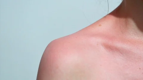 Reddened shoulder of a young girl after sunburn macro Stock Footage 107937053
