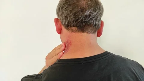 Redness after neck stiffness, redness on the neck, a man's neck is red and br 스톡 동영상 170558365