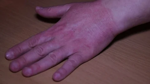 Redness And Allergy On Hand Stock Footage 71581394