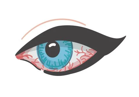 Redness of the eye. Eyeball disease. Vector illustration. Isolated icon. Cartoon Stock Illustration