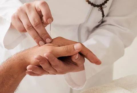 Reflexologist insert acupuncture needle into a patient's wrist hand. Acupunct 写真素材