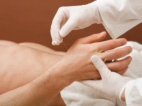 Reflexologist insert an acupuncture needle into a patient's hand. Acupuncture Foto stock