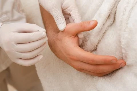 Reflexologist insert an acupuncture needle into a patient's hand. Acupuncture 写真素材