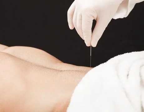 Reflexologist inserts an acupuncture needle into a special spot on a man st.. Foto stock