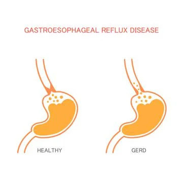 Reflux  disease Stock Illustration