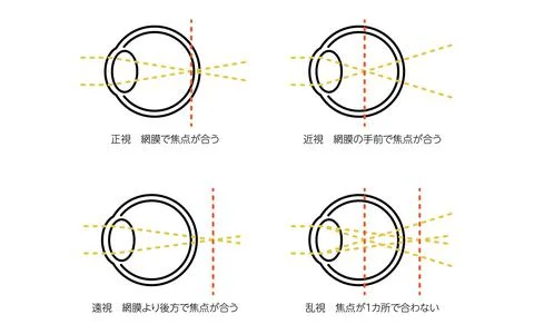 Refractive Error, Normal, Myopia, Hyperopia, Astigmatism - Translation: Orthopia Stock Illustration
