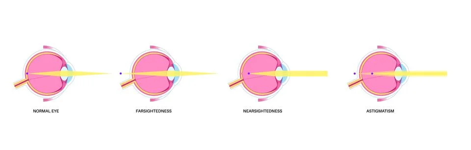Refractive errors poster Illustrazione stock