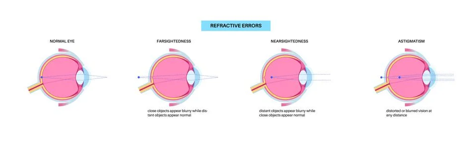 Refractive errors poster Illustrazione stock