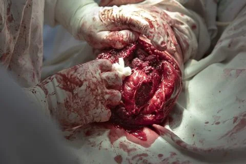 Remainder The Leg During Amputation Фото
