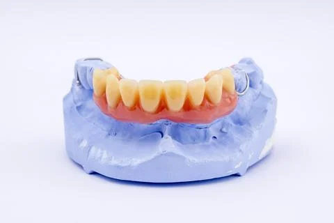 Removable denture of an upper jaw denture denture dentist dental impression Stock Photos