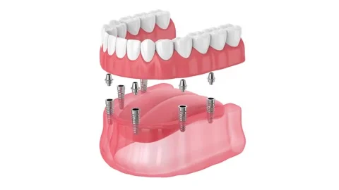 Removable full implant denture over white background Stock Footage