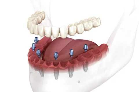 Removable mandibular prosthesis all on 6 system supported by implants. Stock Illustration