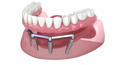 Removable Mandibular prosthesis with gum All on 4 system supported by implant Stock Footage 129240962